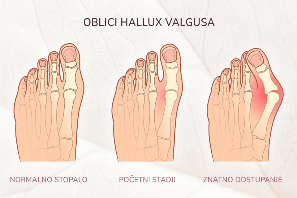 Čukalj - Oblici hallux valgusa - Body Lab