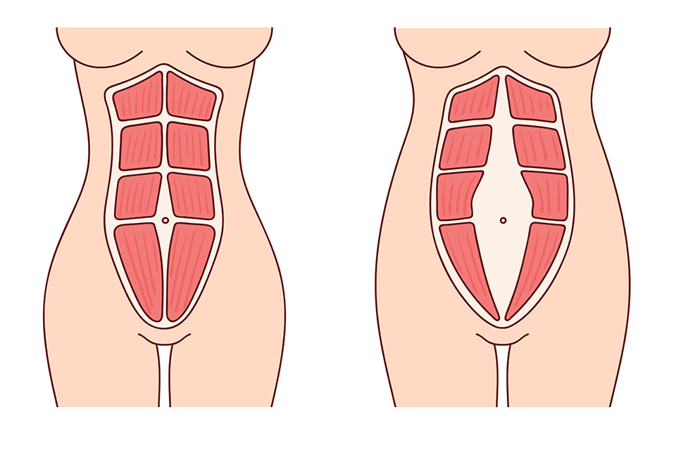 Dijastaza - Jedan od najčešćih razloga zašto trbuh ne nestaje nakon poroda