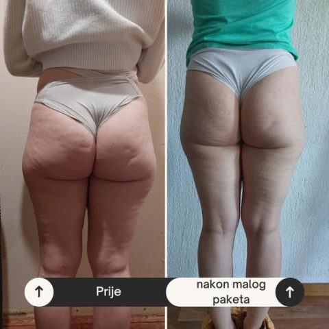 Smanjivanje celulita - Rezultati