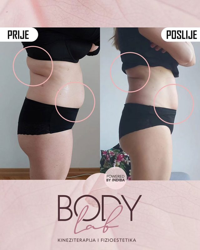 Uklanjanje viška masnog tkiva - Rezultati