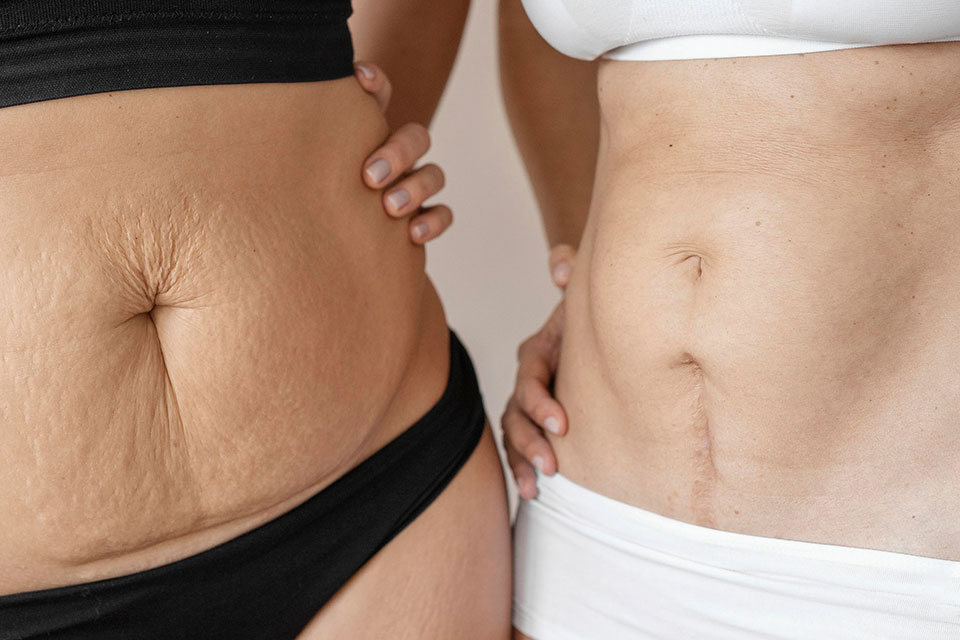 Vježbe za dijastazu: što raditi, a što izbjegavati